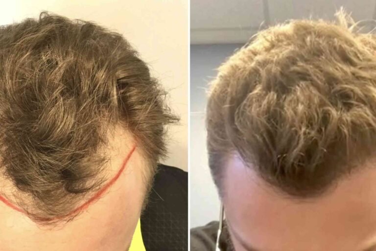Hair Transplant Turkey